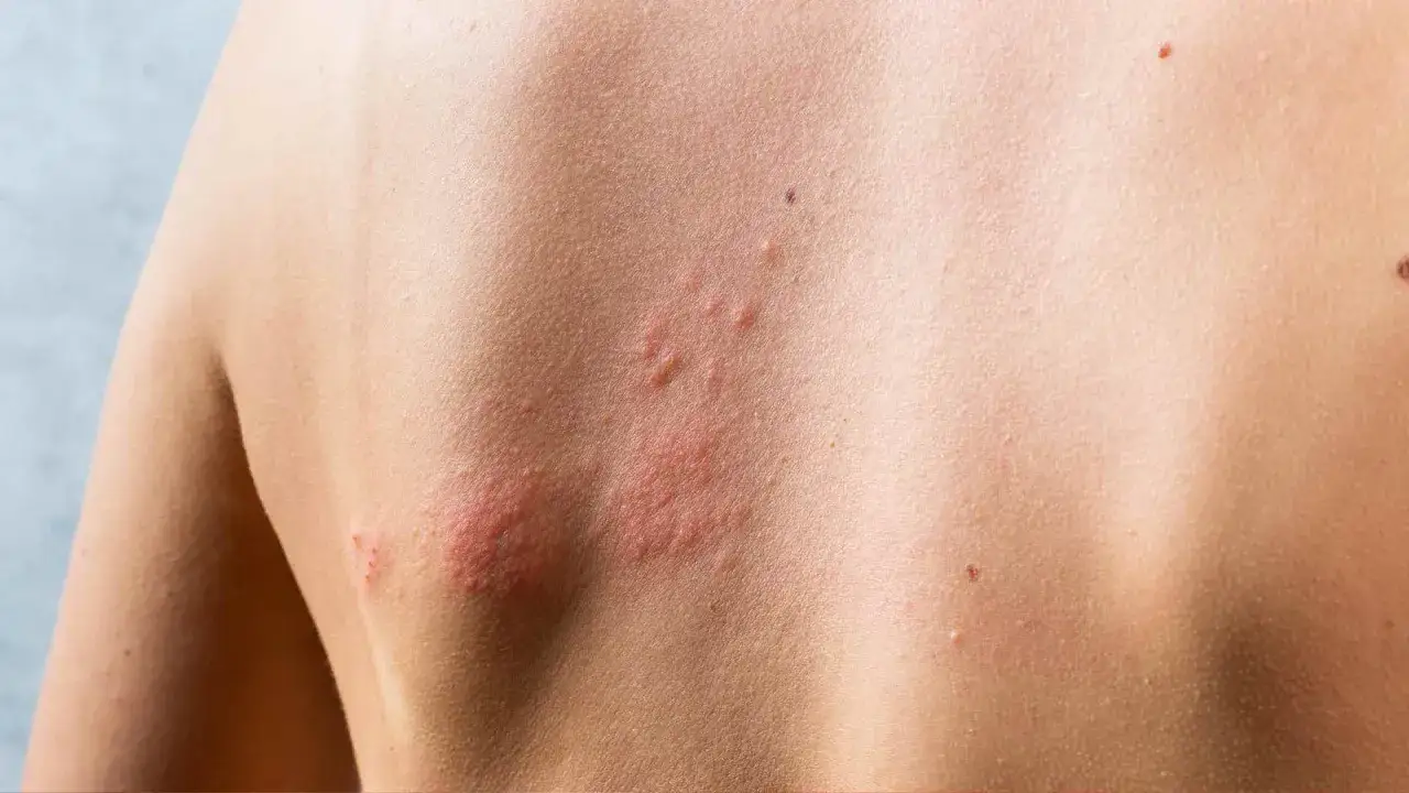 Un primer plano de la espalda de una persona muestra varias &aacute;reas de ronchas en la piel sin picor, algunas con peque&ntilde;as ampollas.