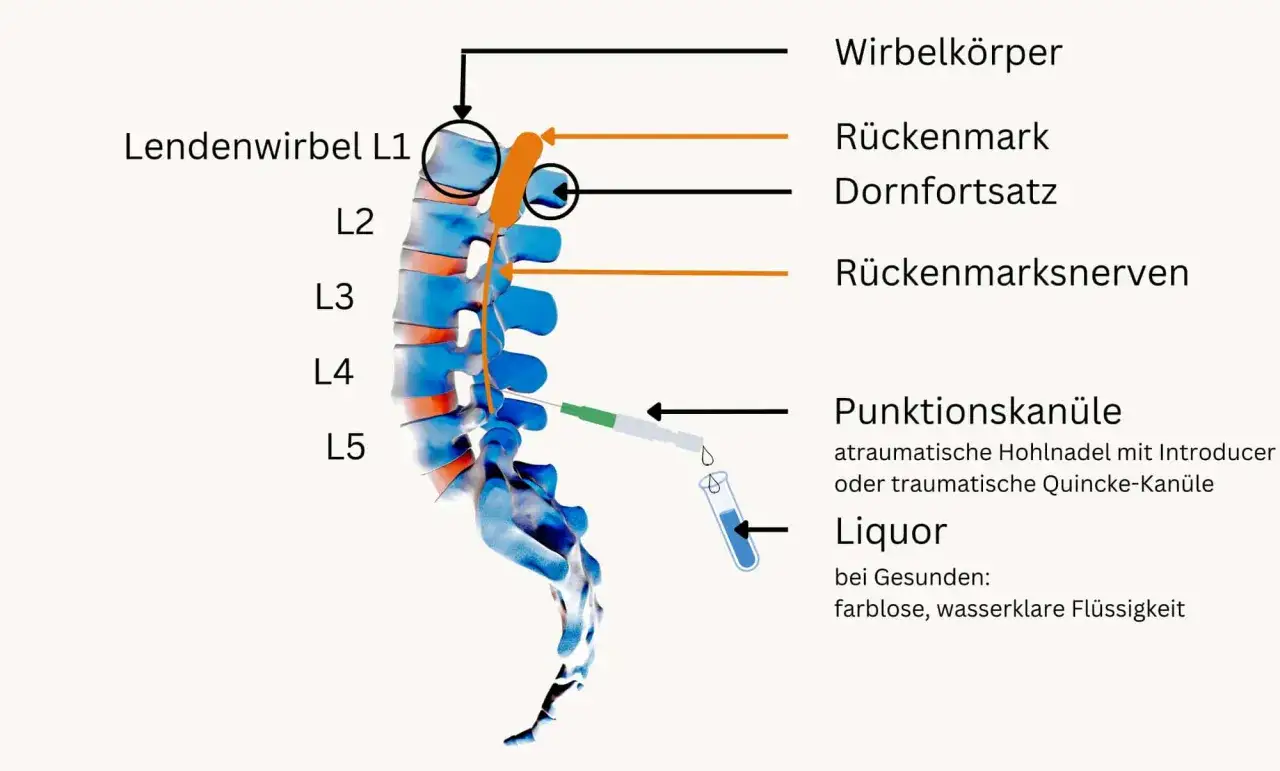 Illustration zeigt Lumbalwirbelsäule mit Punktionskanüle. Mögliche Nervenreizung nach Lumbalpunktion durch Nadelpositionierung nahe den Rückenmarksnerven.