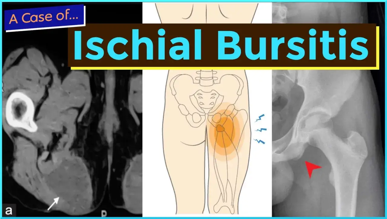 Immagine mostra risonanza magnetica e radiografia dell'anca, con schema che evidenzia dolore alle ossa ischiatiche dovuto a borsite.