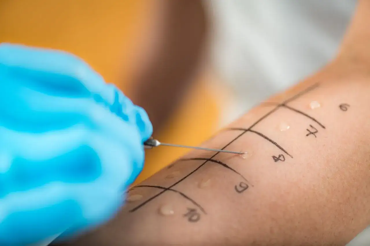 Ręka z zaznaczonymi polami do testów na alergie. Igła delikatnie nakłuwa skórę, rozpoczynając diagnostykę.