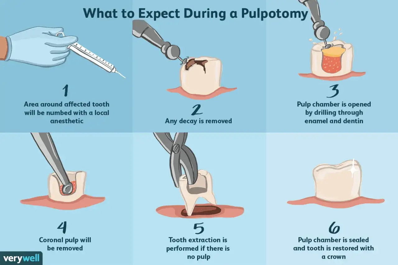 Ilustración explica qué es una pulpotomía: anestesia, limpieza de caries, apertura de la cámara pulpar, remoción de pulpa coronal, y sellado/restauración.
