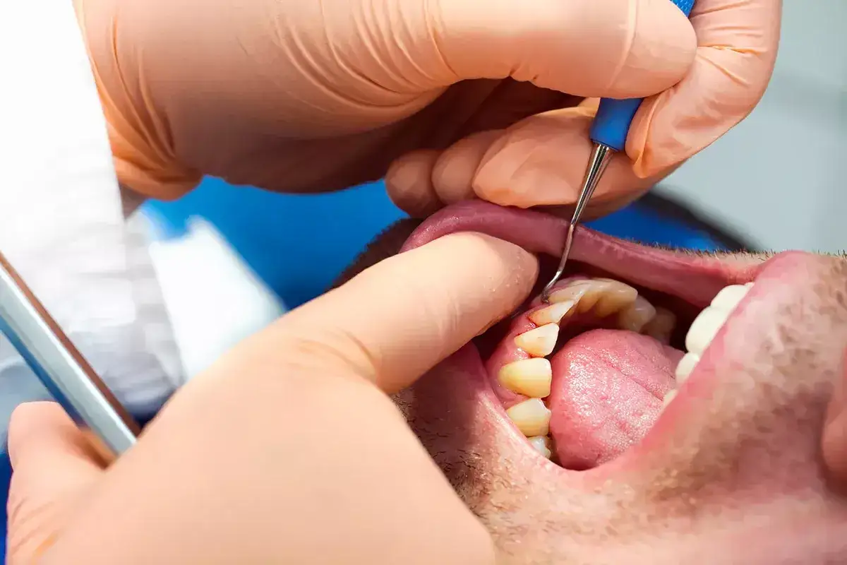 Dentista examina dientes para tratar periodontitis.