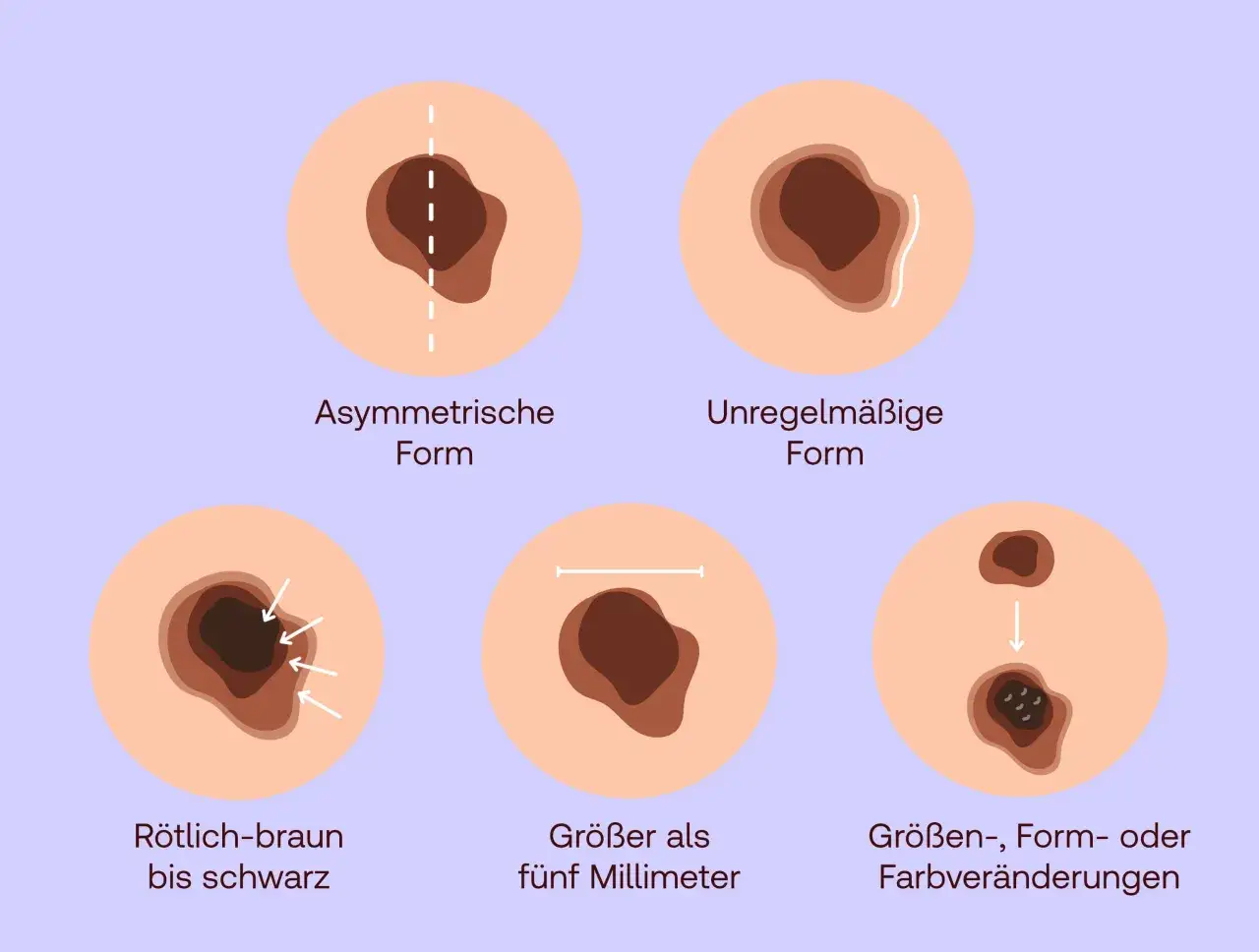 Merkmale von Hautver&auml;nderungen, die auf wei&szlig;en Hautkrebs hindeuten k&ouml;nnten: asymmetrische Form, unregelm&auml;&szlig;ige R&auml;nder, r&ouml;tlich-braune bis schwarze Farbe, Gr&ouml;&szlig;e &uuml;ber 5 mm und Ver&auml;nderungen in Gr&ouml;&szlig;e, Form oder Farbe.