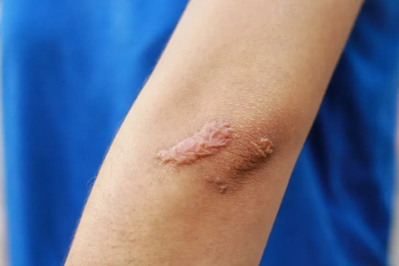 Ein Keloid Narbe am Arm. Suche nach Keloid Hausmittel zur Linderung.