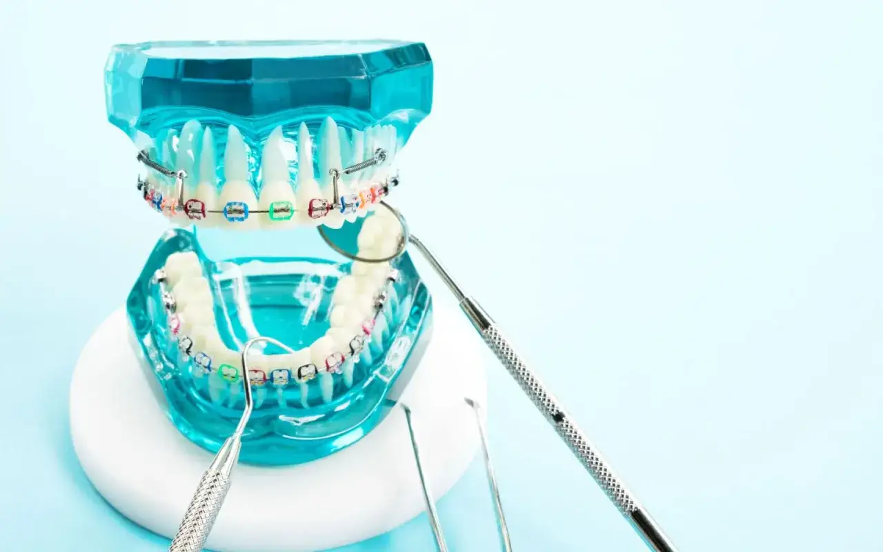 Model szczęki z kolorowym aparatem ortodontycznym i narzędziami dentystycznymi. Czy zakładanie aparatu boli? To pytanie zadaje sobie wiele osób.