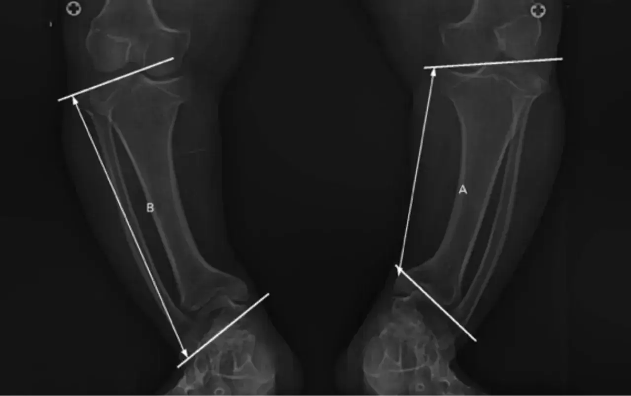 Radiograf&iacute;as de piernas con mediciones. Podr&iacute;an ser &uacute;tiles para entender la acondroplasia que es.