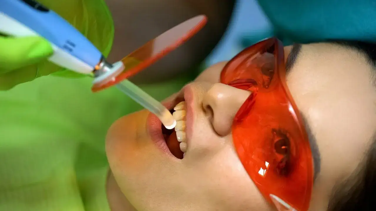 dentysta zakładający plombę kompozytową