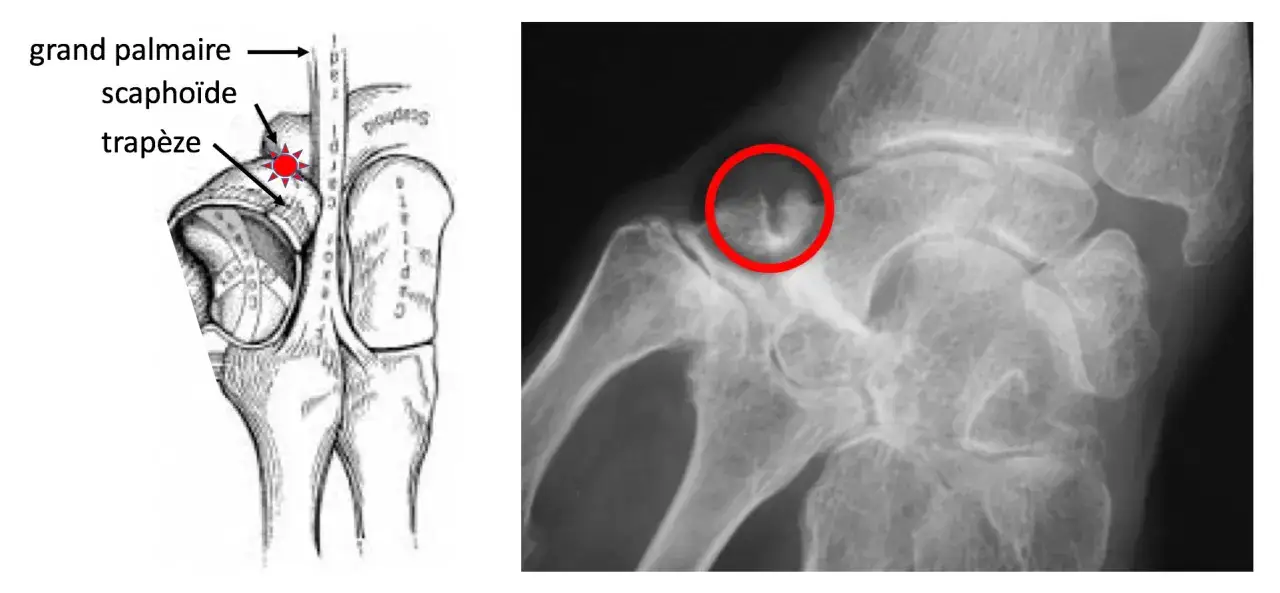 Dessin anatomique et radiographie du poignet. La radiographie montre une fracture du scapho&iuml;de, expliquant le poignet gonfl&eacute;.