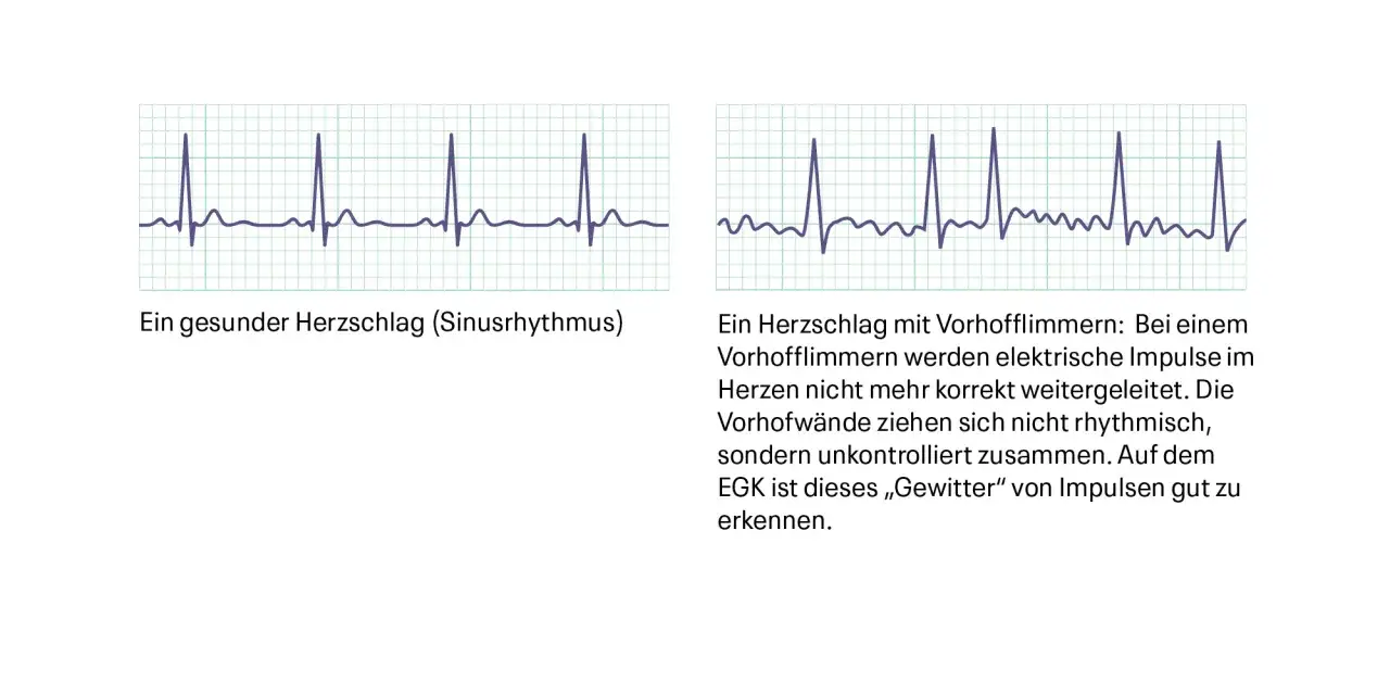 Vergleich von EKG-Kurven: gesunder Sinusrhythmus vs. Vorhofflimmern, ein Beispiel f&uuml;r nicht defibrillierbare Rhythmen.