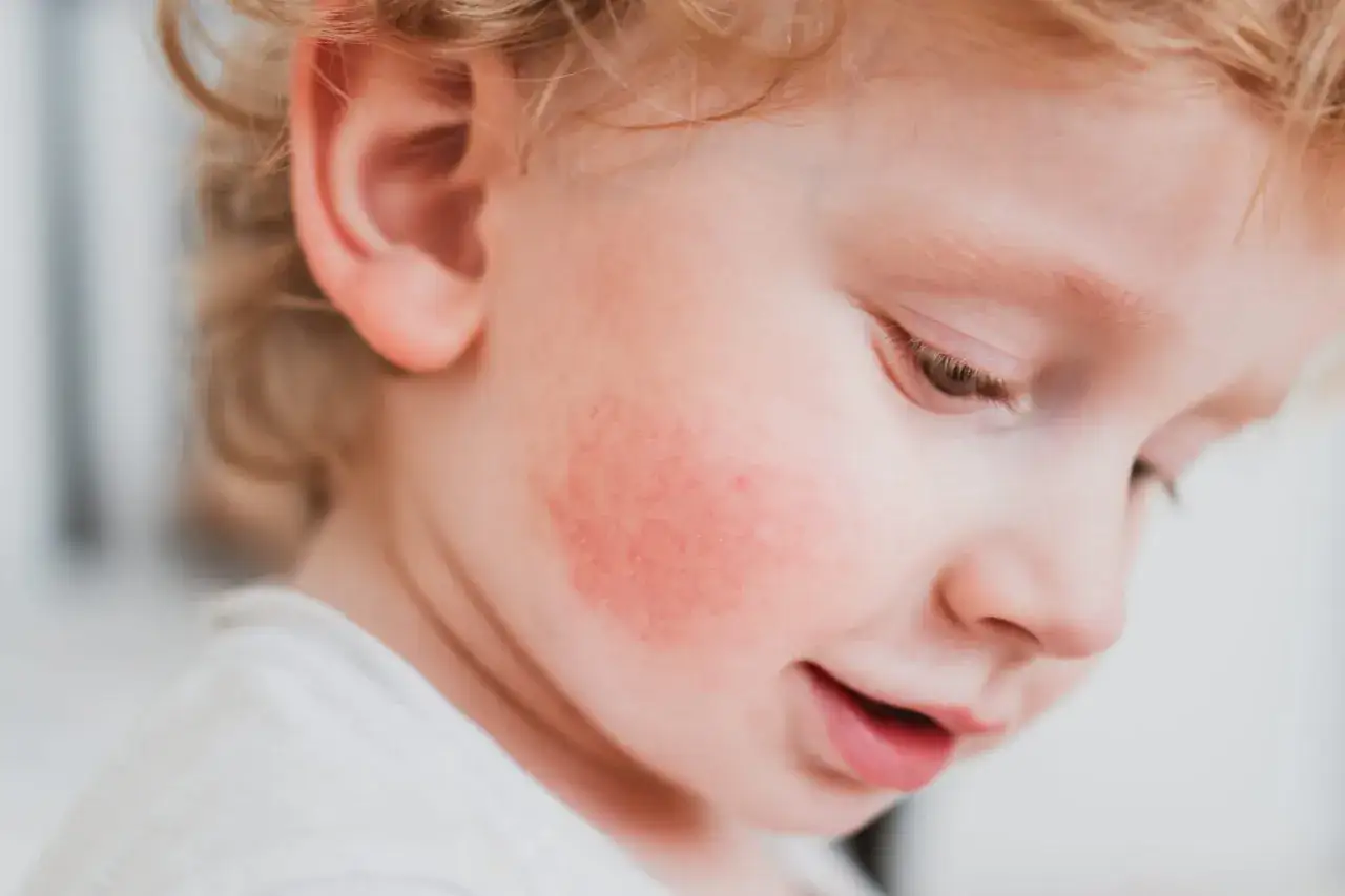Enfant avec une rougeur sur la joue, possiblement du pityriasis alba. Le traitement est souvent simple.