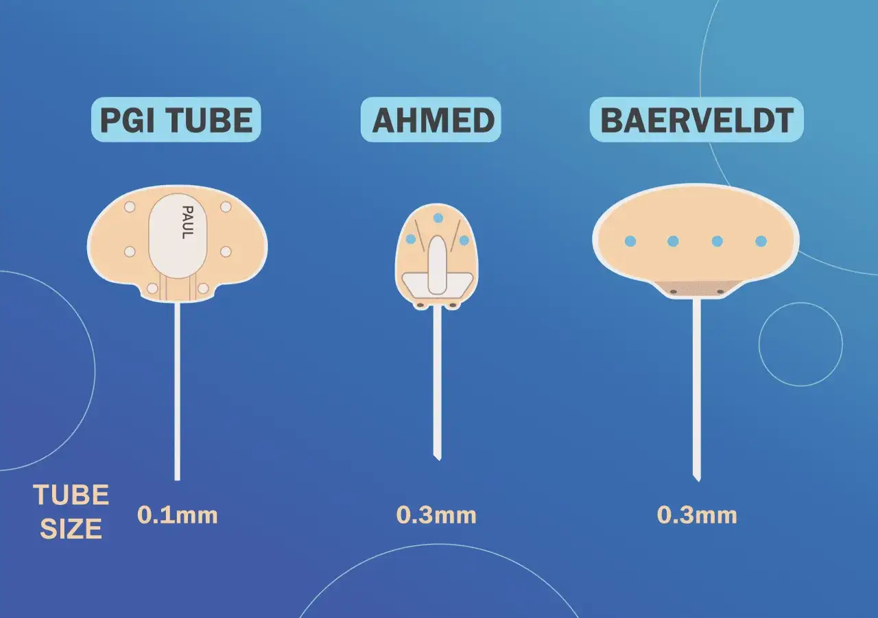 Tre dispositivi per l'intervento glaucoma con tubicino: PGI Tube (0.1mm), Ahmed e Baerveldt (0.3mm).