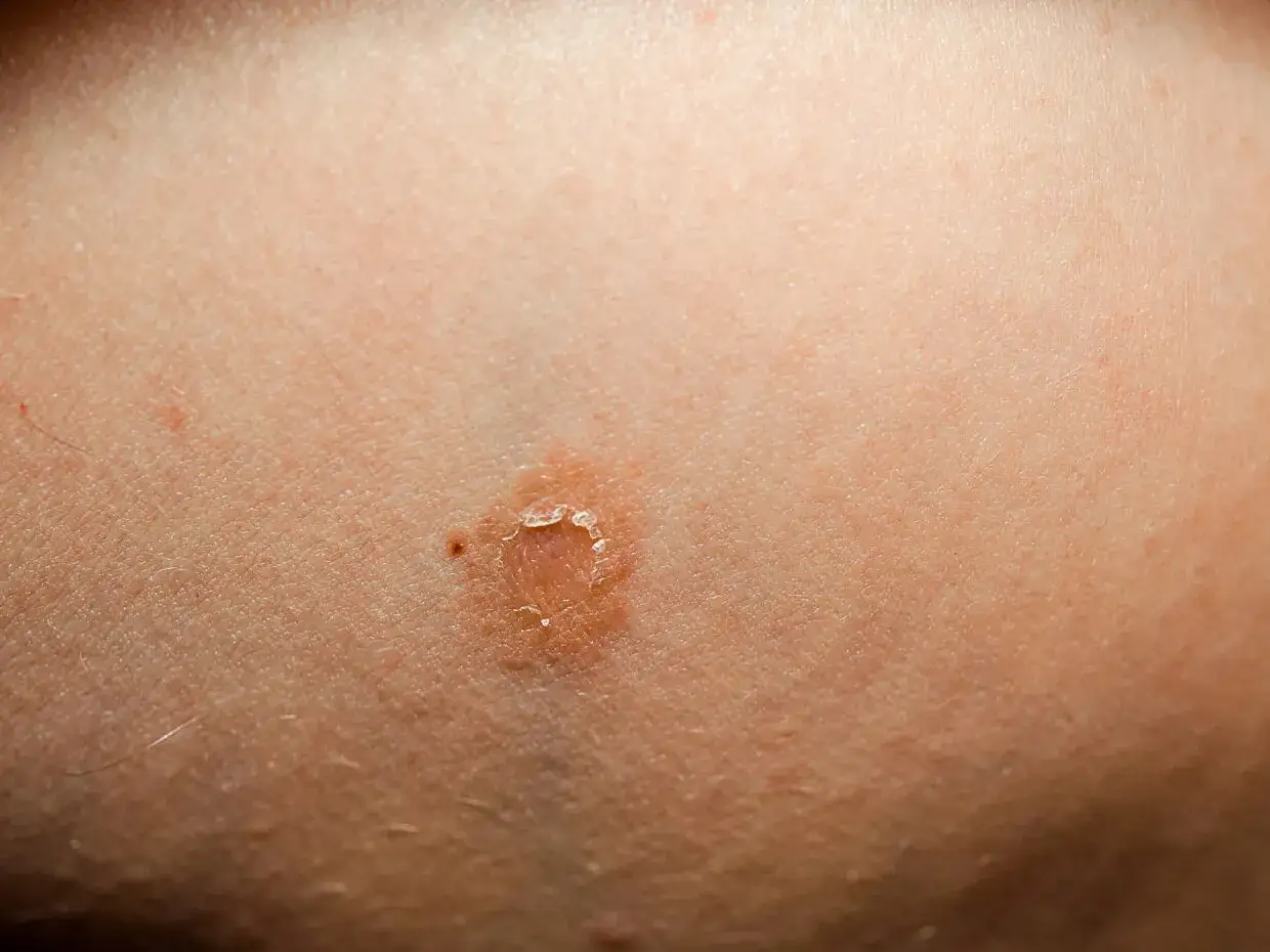 Macchia cutanea con desquamazione, possibile sintomo di pitiriasi rosea di Gibert, spesso legata allo stress.
