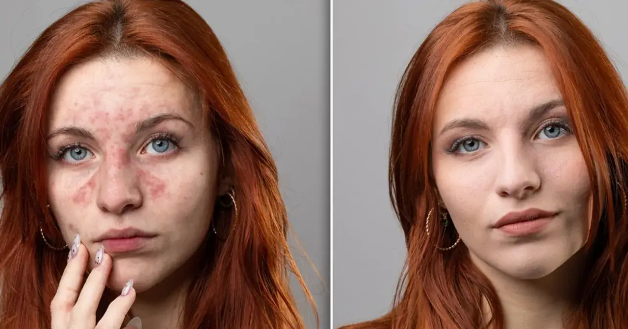 krem cc do cery naczynkowej przed i po