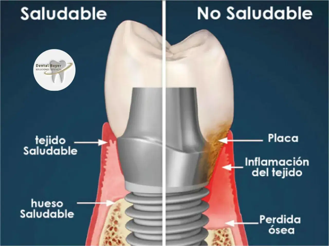 Comparación de implantes dentales: lado saludable con tejido y hueso sanos, versus lado no saludable con placa, inflamación y pérdida ósea, indicando posibles problemas.