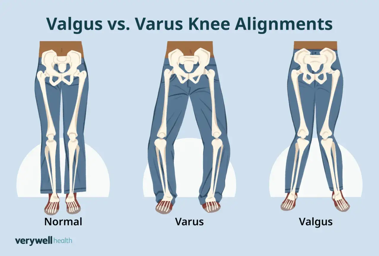 Vergleich von normalen, Varus- und Valgus-Knieausrichtungen. Die Abbildung zeigt drei Skelette mit unterschiedlichen Beinachsen, die als