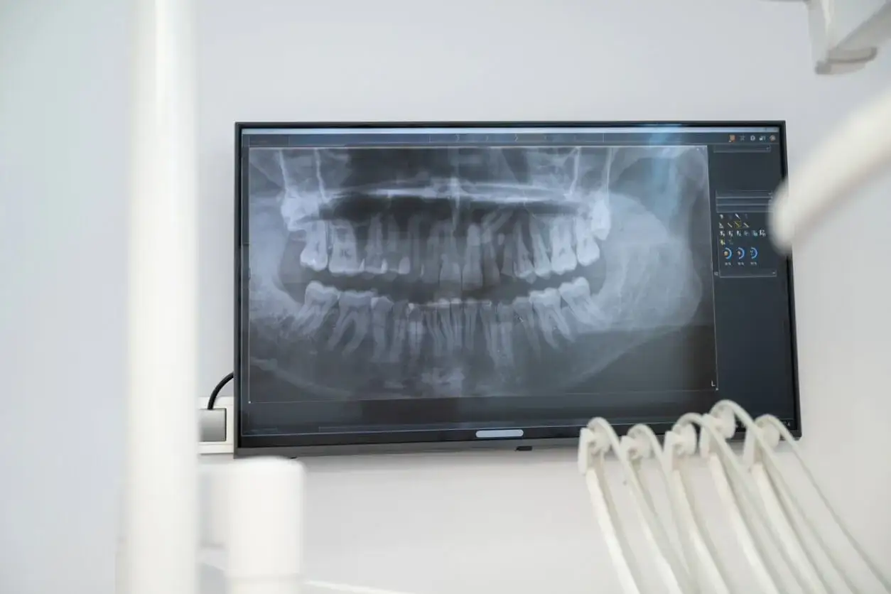 Radiografia dentale mostra un'infezione ai denti. La VES alta indica infiammazione nel corpo.