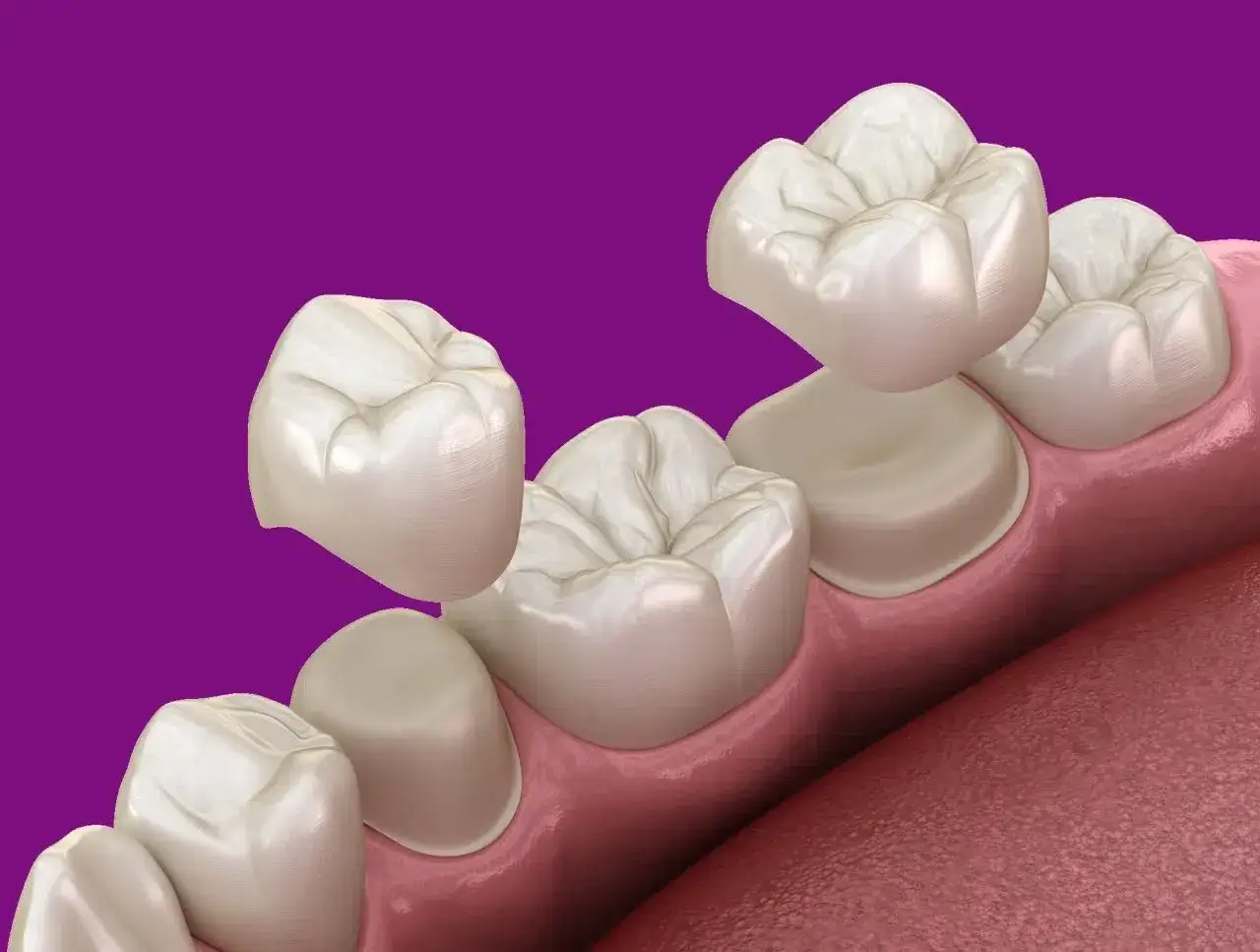Model zębów z koroną, gotową do osadzenia. Precyzja, z jaką wykonano ten element, świadczy o pracy doświadczonego **technika dentystycznego**.