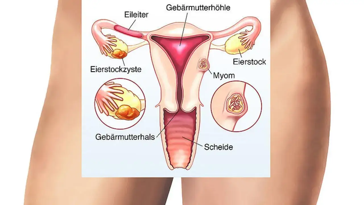 Anatomie des weiblichen Unterleibs mit Geb&auml;rmutter, Eierst&ouml;cken, Eileitern und Scheide. M&ouml;gliche Ursachen f&uuml;r unterleibsschmerzen ohne periode: Eierstockzyste, Myom.