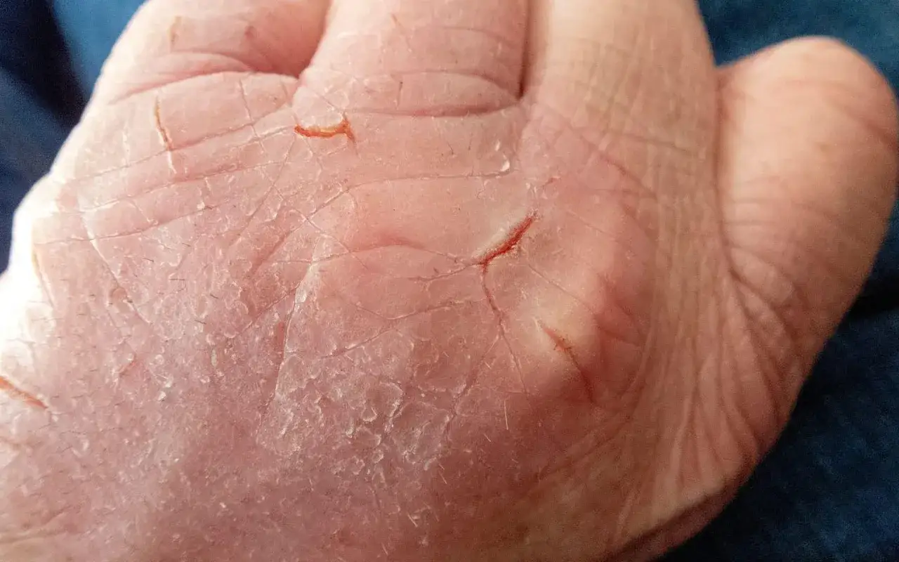 När huden blir torr och sprucken kan det kännas obehagligt. Här syns tydligt torra knogar med små sprickor, som kan vara smärtsamma.