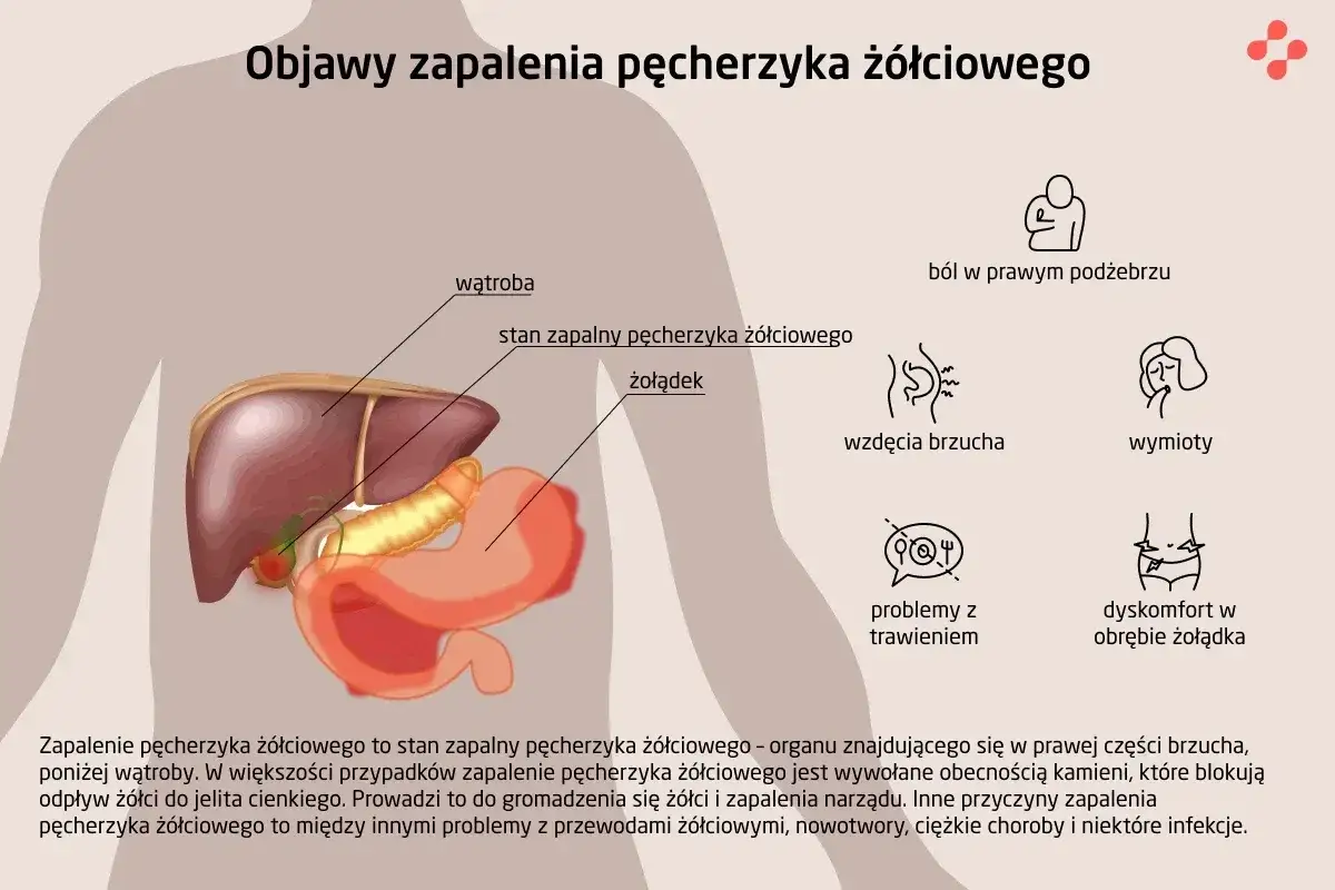 Ilustracja przedstawia anatomię jamy brzusznej z zaznaczonym zapaleniem pęcherzyka żółciowego, wątrobą i żołądkiem. Wymienione objawy to ból, wzdęcia, wymioty i problemy z trawieniem.
