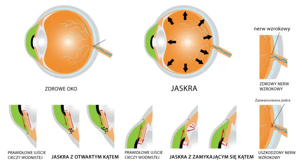 Jaskra chroniczna a ostry atak jaskry porównanie
