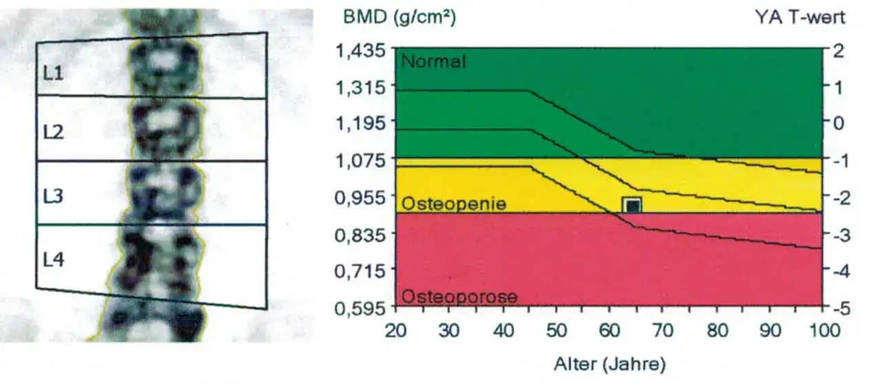 Knochen-Densitometrie-Ergebnisse: Die Osteoporose Werte Tabelle zeigt den T-Wert im Verh&auml;ltnis zum Alter.