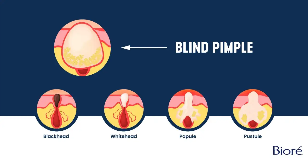 Illustration av olika stadier av akne: blackhead, whitehead, papule och pustule. En inflammerad finne visas i n&auml;rbild.