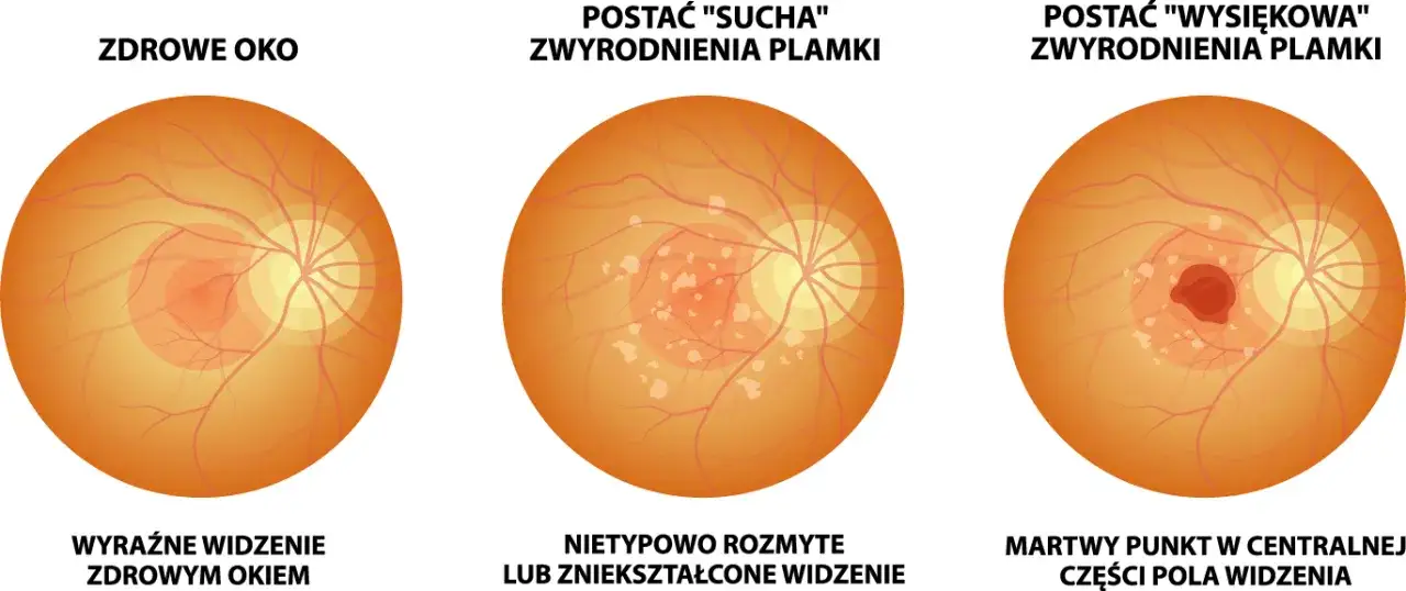 AMD wysiękowe oko siatk&oacute;wka
