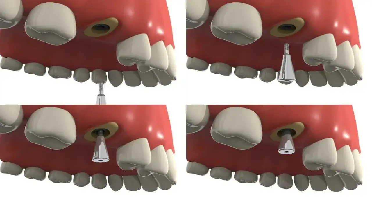 Secuencia de colocación de un implante dental. El implante se inserta en la encía para reemplazar un diente perdido.
