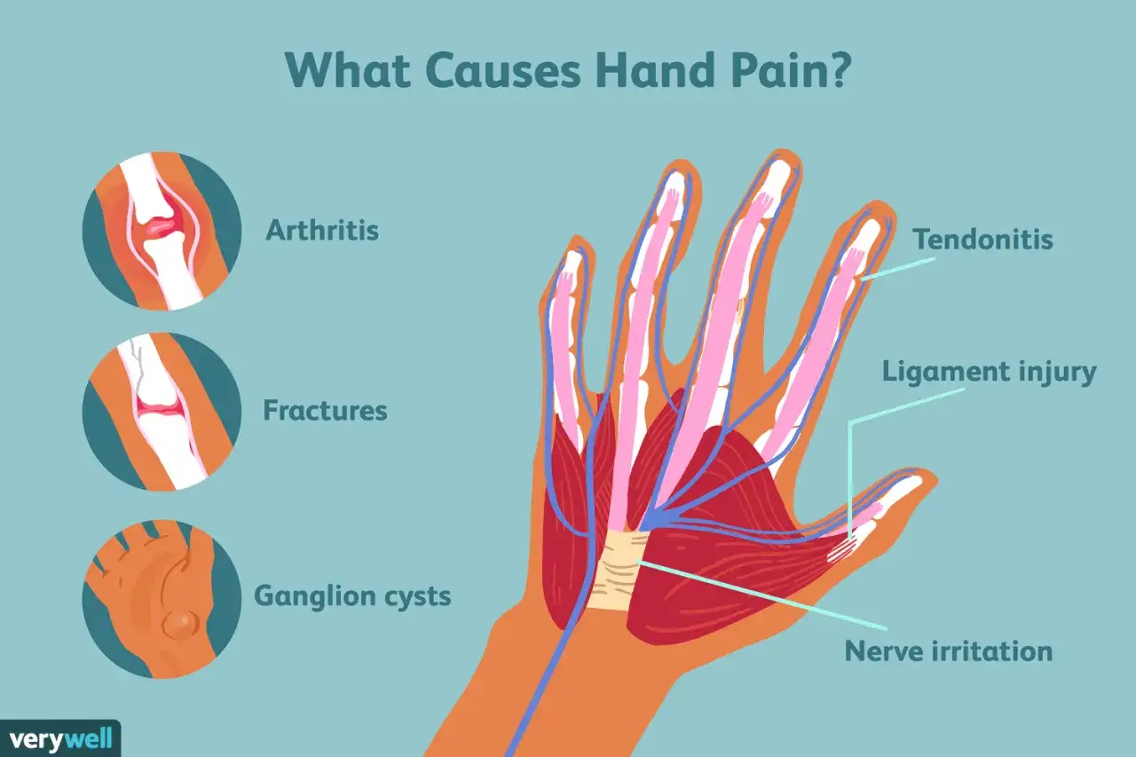Ilustración de la mano mostrando huesos, tendones y nervios, con etiquetas para artritis, fracturas, quistes ganglionares, tendinitis, lesión de ligamentos e irritación nerviosa.