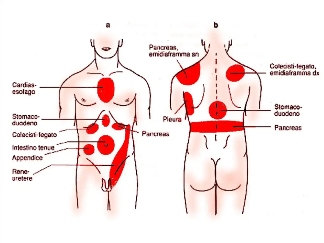 Dolori che indicano dove fa male quando si ha la colite: aree rosse su torace, addome e schiena, con indicazioni anatomiche.