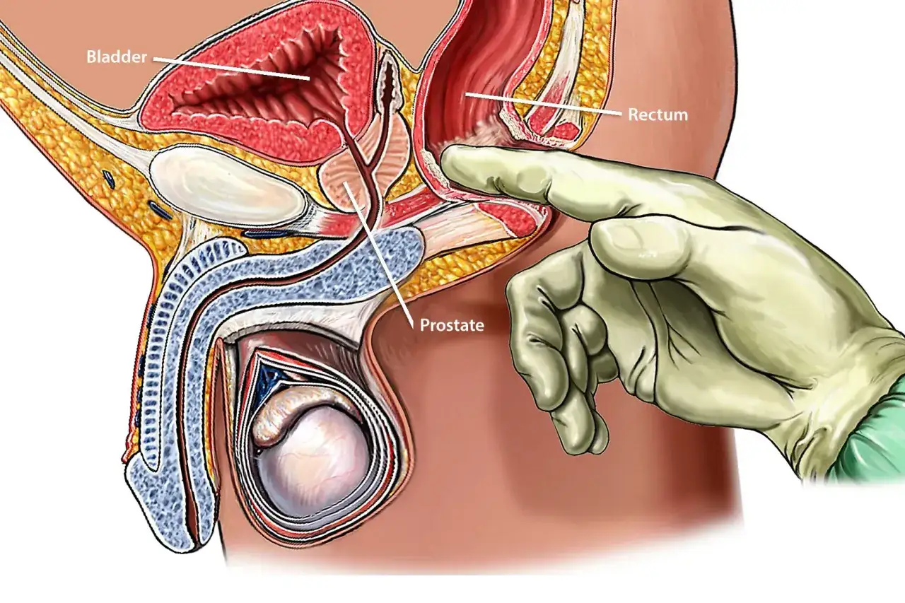 Ilustracja pokazuje badanie per rectum, kluczowe dla samodzielnego badania prostaty.