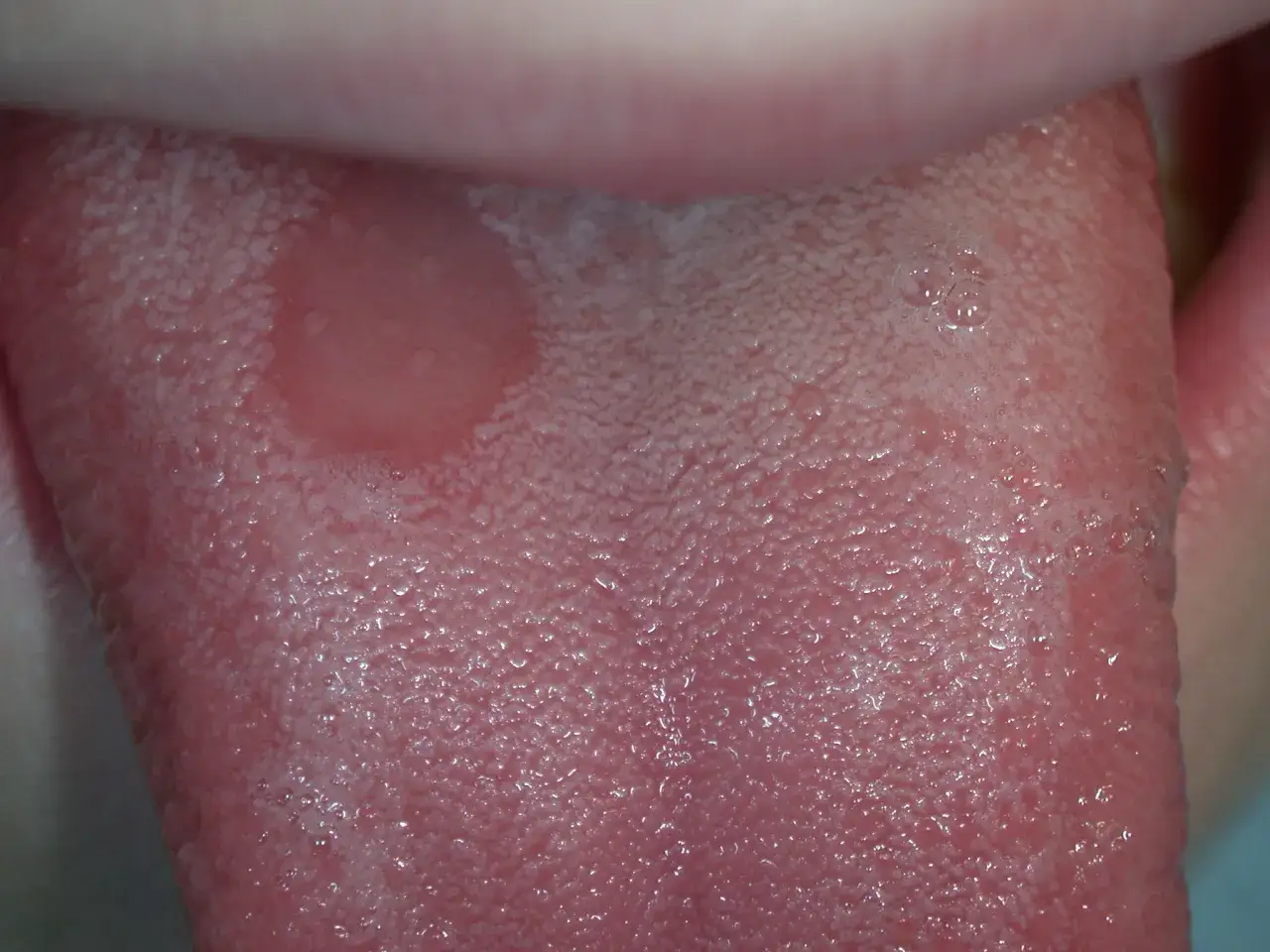 Lingua con afte, un sintomo comune nella celiachia. Le papille gustative appaiono gonfie e irritate.