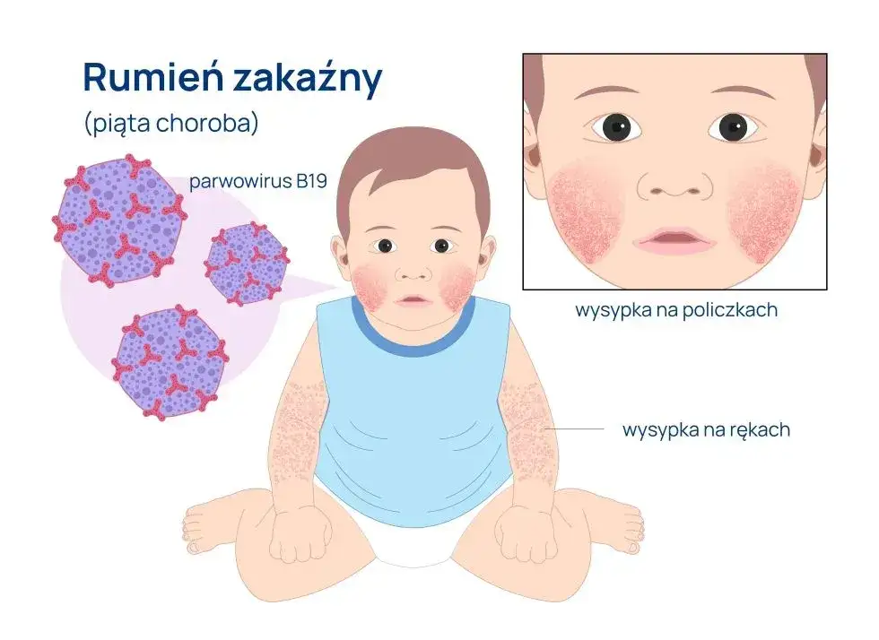 objawy chorób zakaźnych grafika