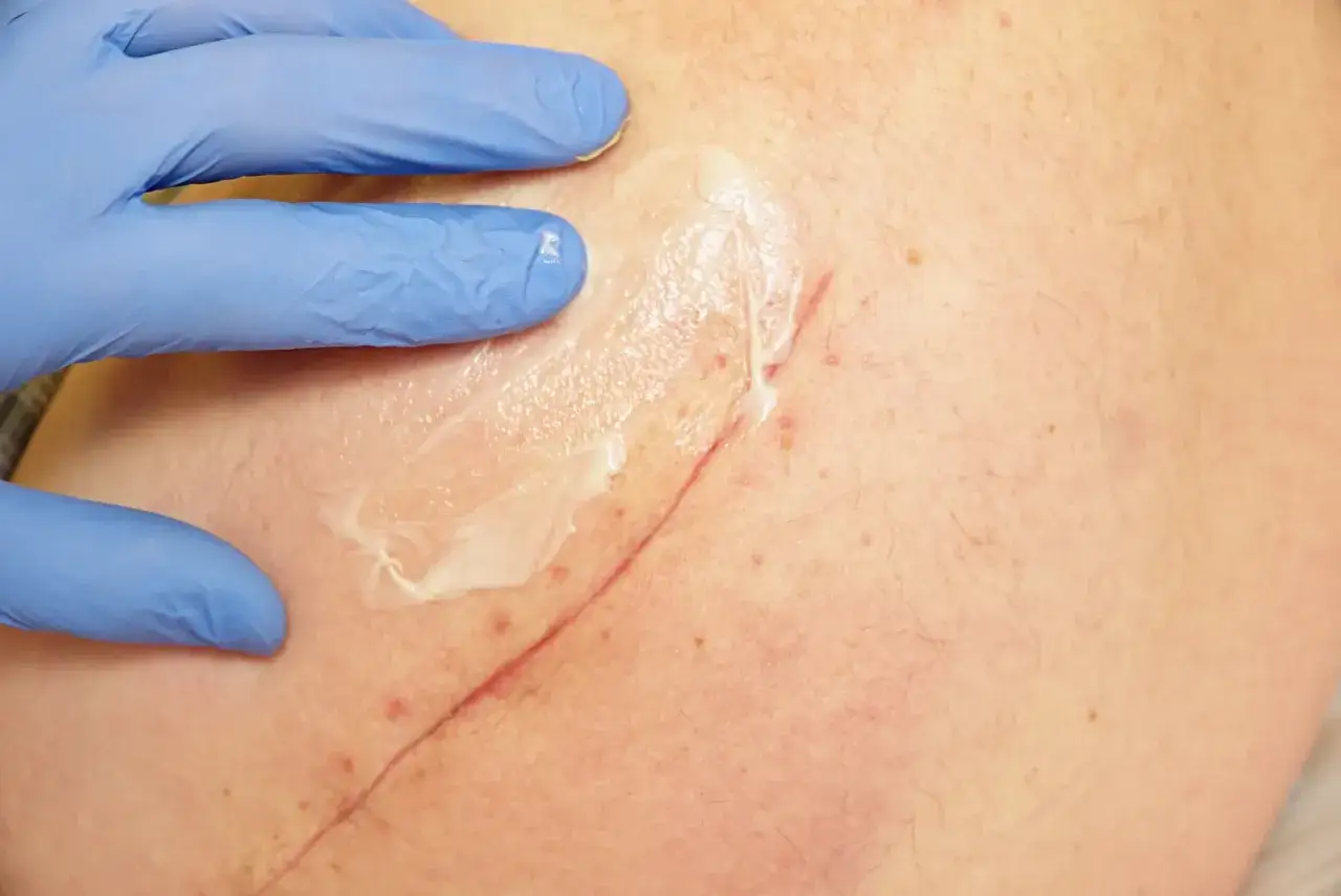 Main d'une personne portant un gant bleu appliquant une cr&egrave;me sur une peau l&eacute;s&eacute;e avec une cicatrice.