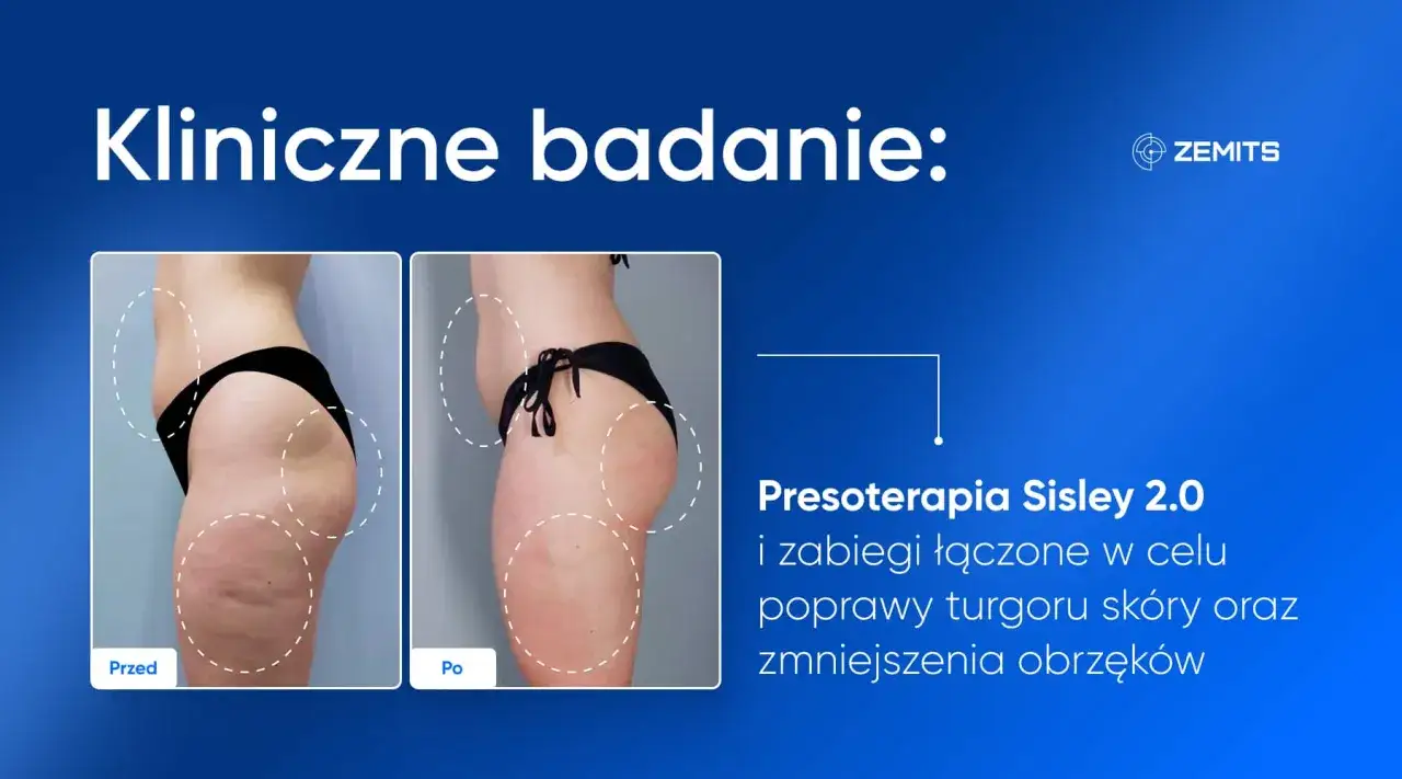 Przed i po zabiegu presoterapii. Widoczne znaczące limfodrenaż efekty: wygładzona skóra, redukcja cellulitu i obrzęków.