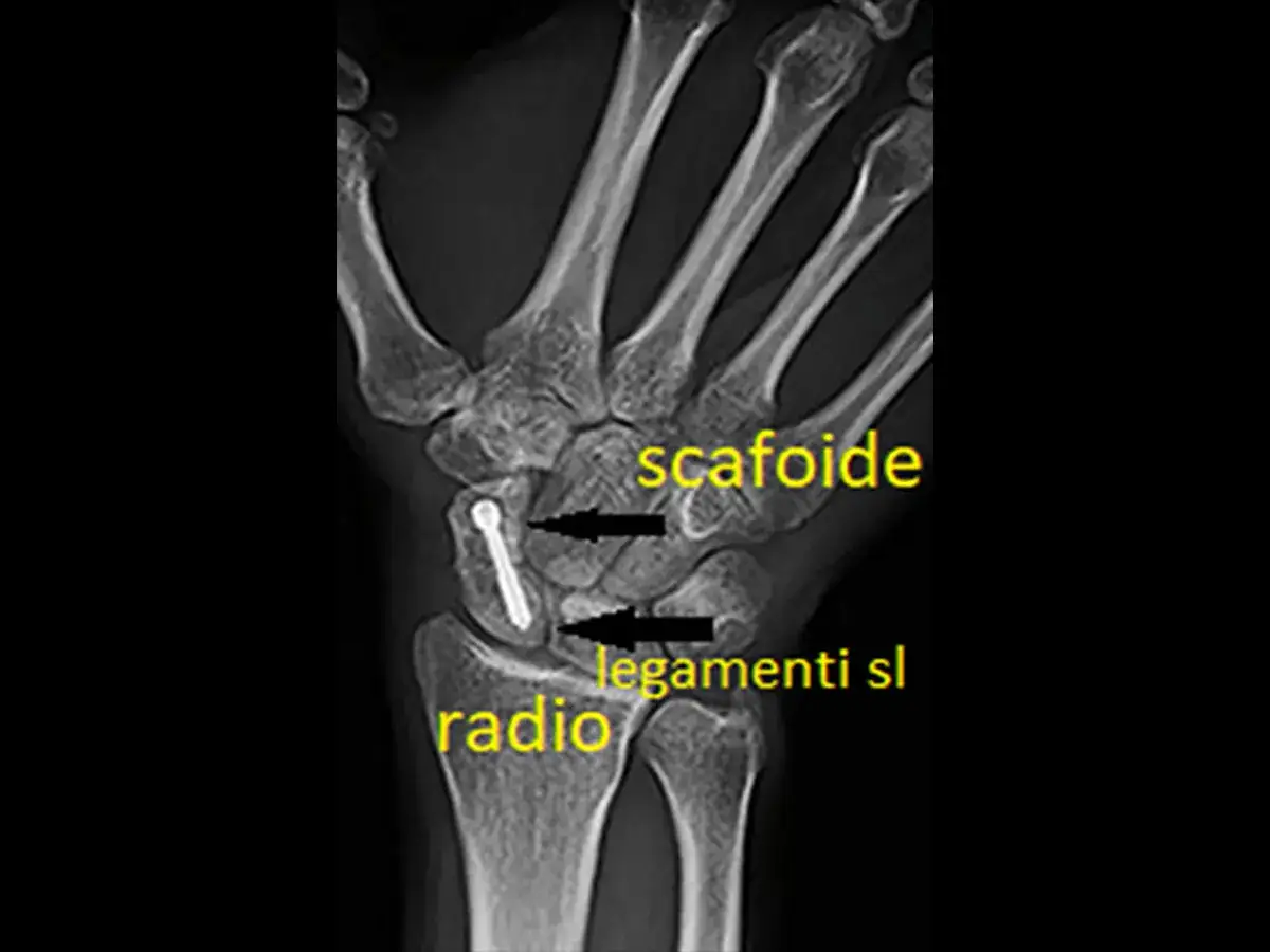 Radiografia del polso con vite nel **scafoide mano**, radio e legamenti evidenziati.