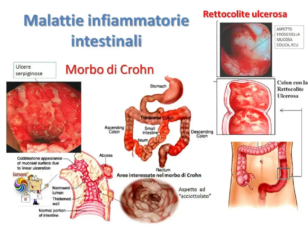 Immagine illustra le malattie infiammatorie intestinali, tra cui il Morbo di Crohn e la rettocolite ulcerosa, con dettagli su ulcere e aspetto del colon.