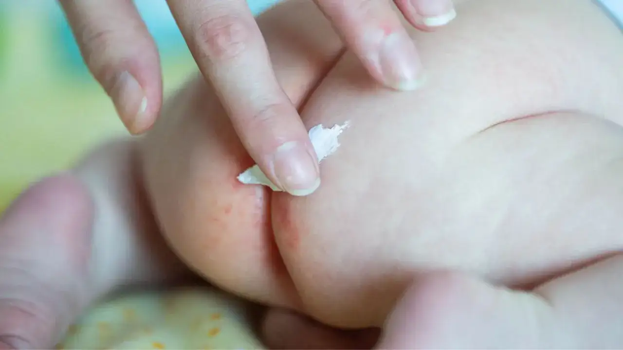 Dito un dito applica crema su un culetto arrossato, per curare la candida da pannolino.