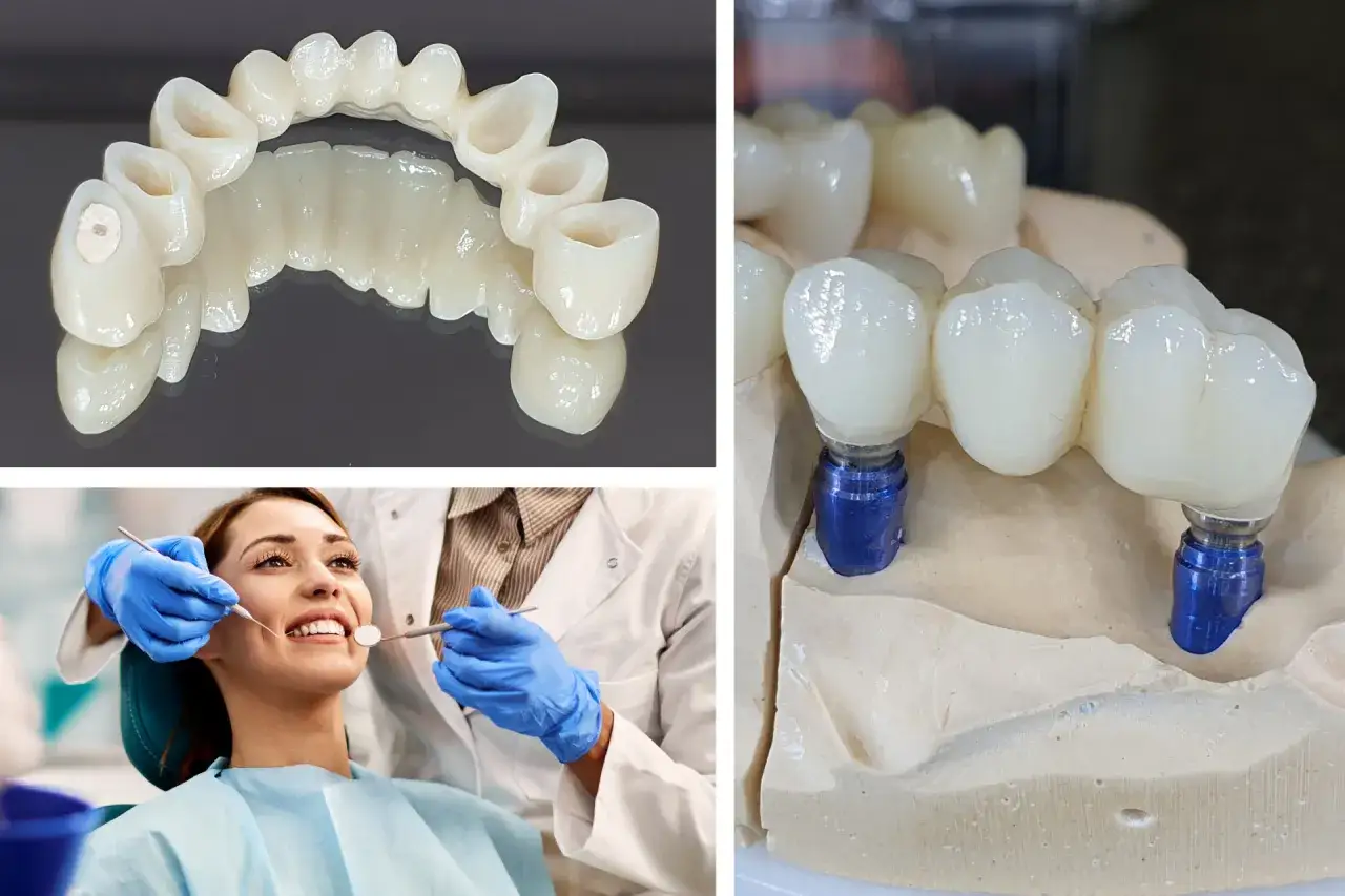 Zdejmowanie mostu z zębów to proces, który przywraca piękny uśmiech. Widoczne są protezy zębowe i wizyta u dentysty.