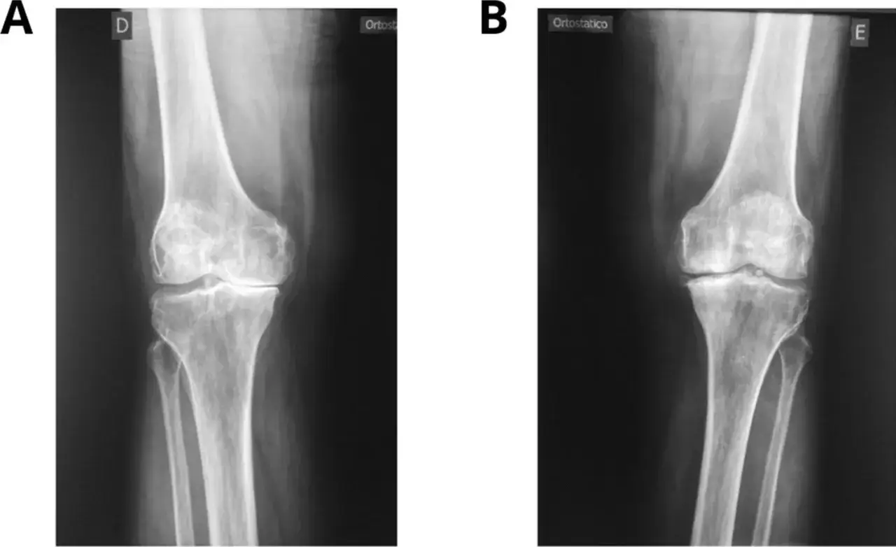 Radiografie del ginocchio che mostrano segni di artrosi, causa di dolore al ginocchio.