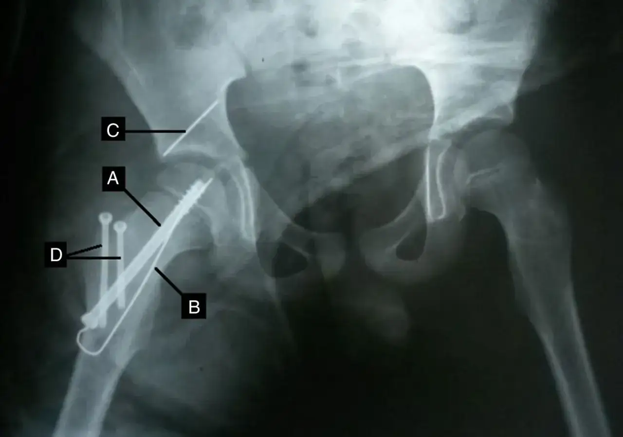 Radiograf&iacute;a de pelvis con fractura en rodete acetabular reparada con tornillos y placa.