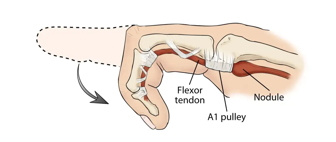 Illustration zeigt einen verdickten Flexorsehnen-Knoten, der die A1-Sehnenrolle blockiert. Dies erkl&auml;rt, wie man einen Schnappfinger behandeln kann.