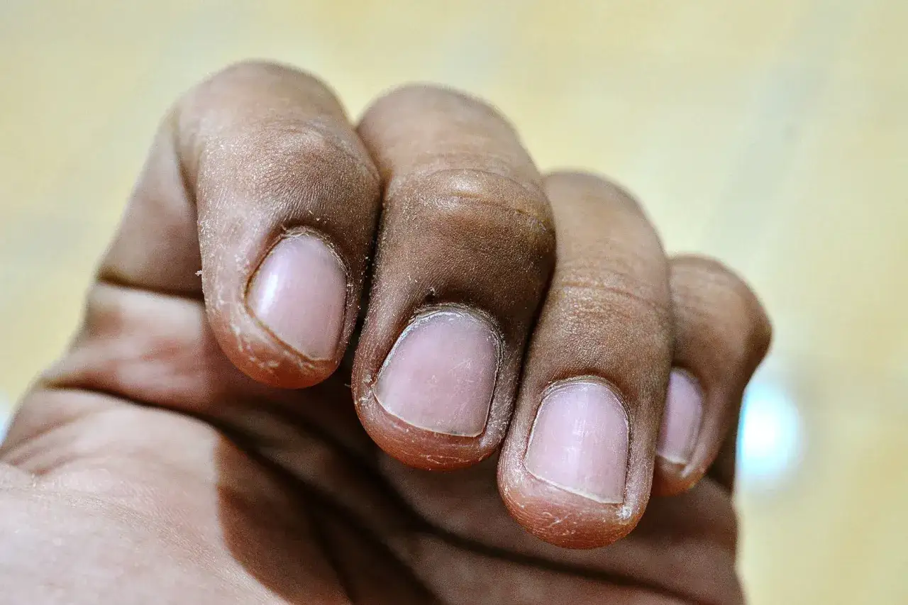 Dedos con piel seca y descamada, mostrando grietas. Busca remedios para curarlas y lucir manos suaves.