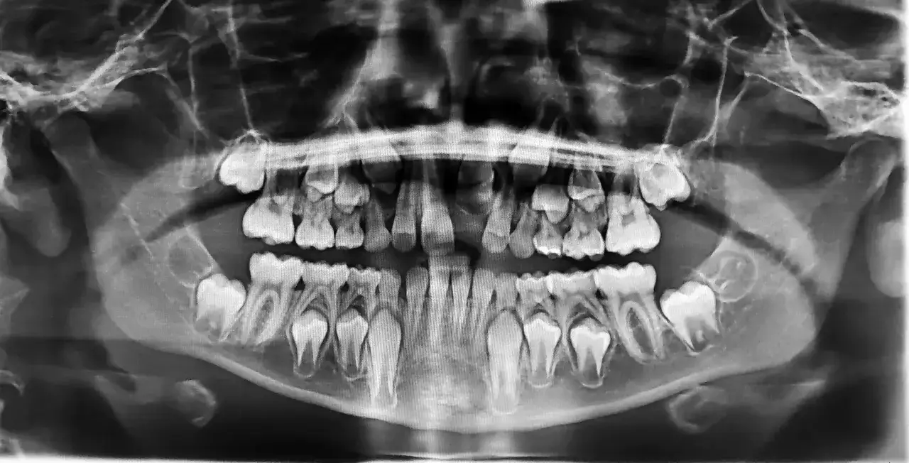 Radiograf&iacute;a panor&aacute;mica dental que muestra la mand&iacute;bula y maxilar. Se observa una posible infecci&oacute;n endodoncia en algunas piezas dentales.