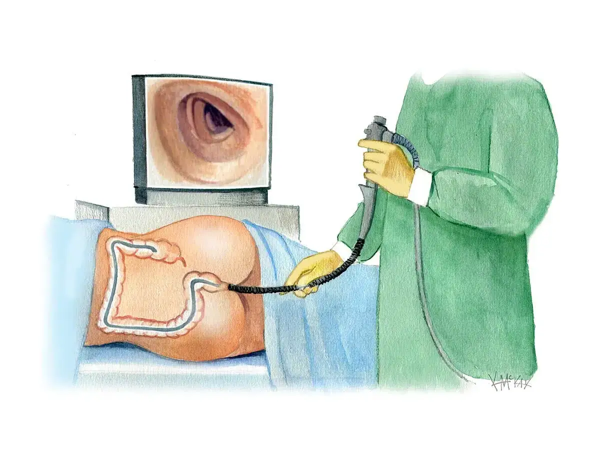 Illustration einer Darmspiegelung. Ein Arzt führt ein Endoskop in den Darm ein, während das Bild auf einem Monitor angezeigt wird. Die Frage, wie lange dauert eine Darmspiegelung, wird hier visuell thematisiert.