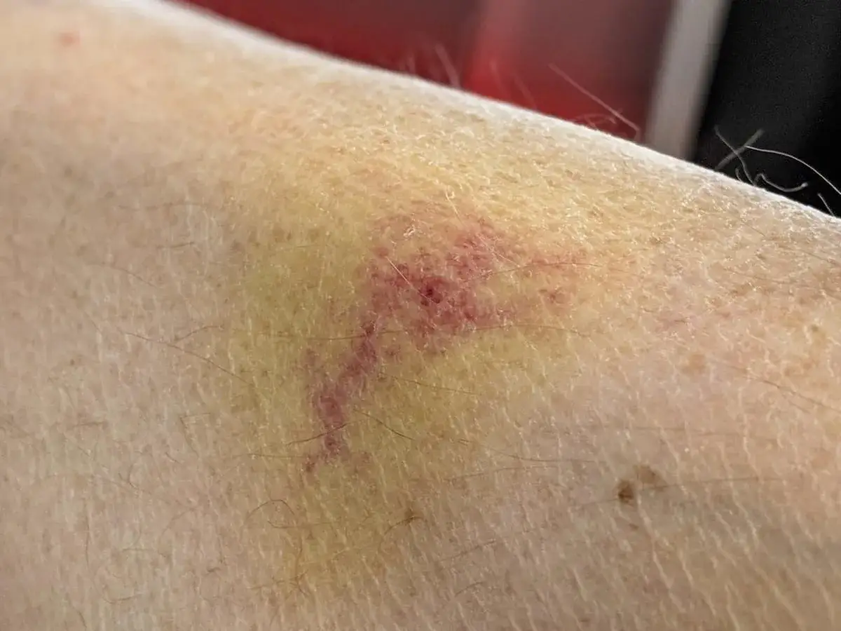 Haut mit gelblich-roter Verf&auml;rbung und feinen &Auml;derchen, typisch f&uuml;r eine wundrose nach insektenstich.
