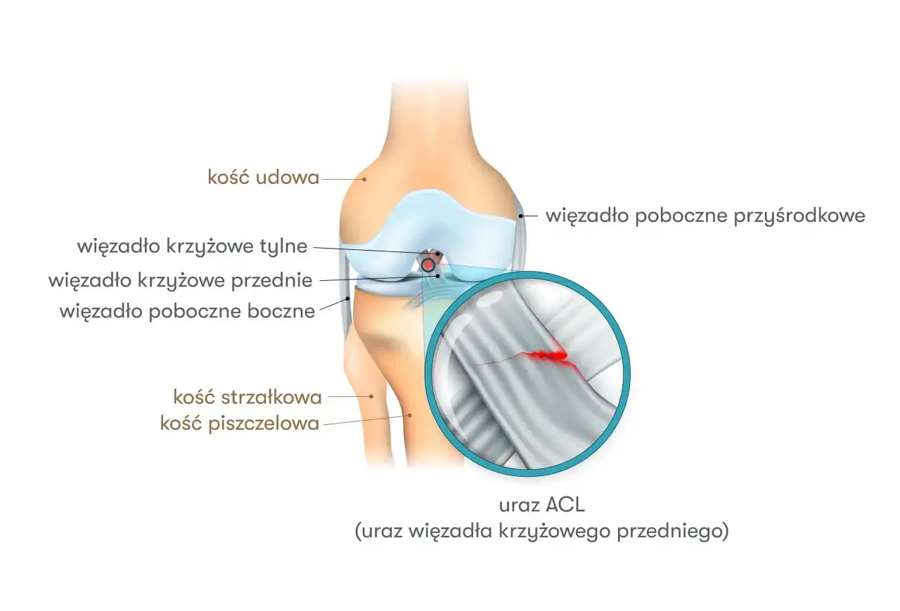 Ilustracja przedstawia kolano z zaznaczonymi więzadłami. Powiększony fragment ukazuje pęknięcie więzadła krzyżowego przedniego, co symbolizuje nieleczone zerwane więzadło krzyżowe.