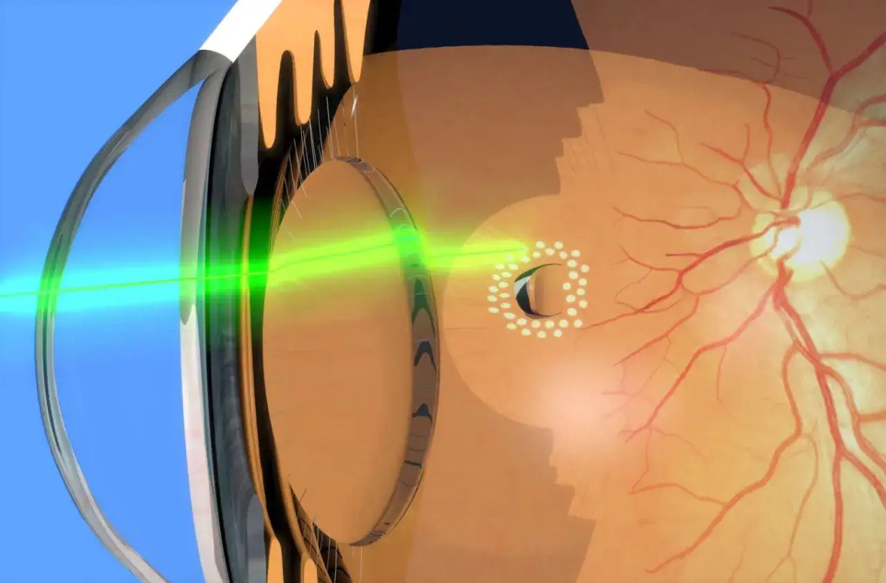 Fascio laser verde colpisce la retina, creando una lesione retinica. Dettaglio anatomico dell'occhio.
