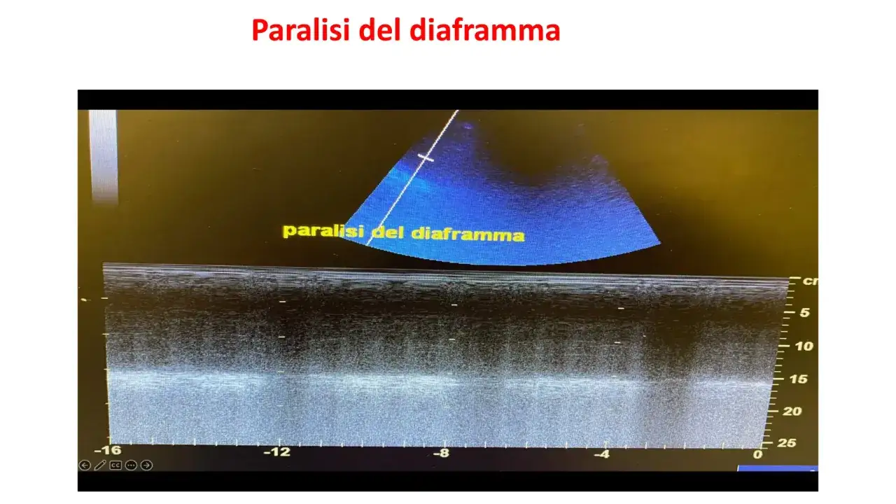 Ecografia mostra un emidiaframma destro sollevato, indicativo di paralisi del diaframma.